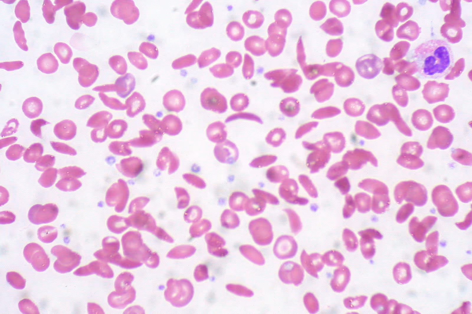 Esfregaço de sangue periférico mostrando hemácias em forma de foice características da anemia falciforme ao lado de hemácias normais Esfregaço de sangue periférico mostrando hemácias em forma de foice características da anemia falciforme ao lado de hemácias normais