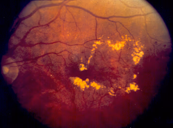 Diabetes e olhos: quando ir ao oftalmologista