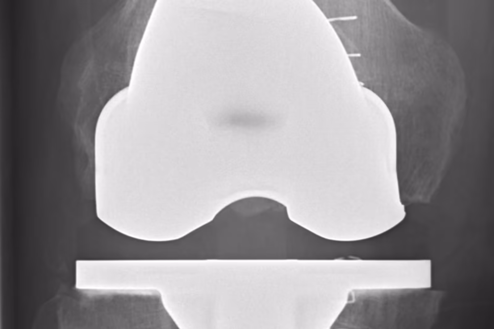 Radiografia de frente de um joelho após colocação de prótese total Radiografia de frente de um joelho após colocação de prótese total